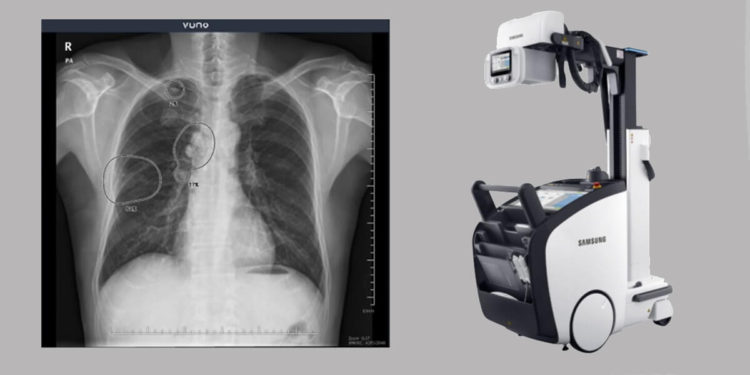 AI-based medical tech startup VUNO partnered with Samsung to integrate the VUNO Med-Chest X-ray diagnostic solution with Samsung’s GM85 X-ray system.